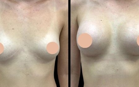 How to Choose the Right Implant Texture for Breast Augmentation in Dubai
