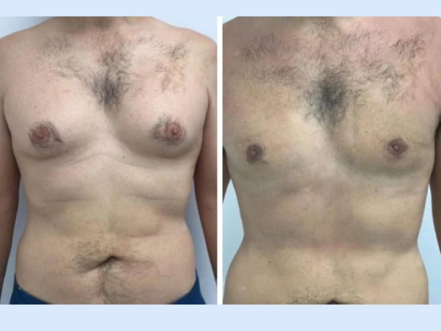 How to Choose the Best Gynecomastia Surgeon in Dubai Based on Their Reputation