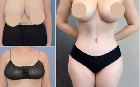 How Much Fat Can Be Removed During a Tummy Tuck in Dubai?