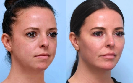 Is Thread Lift Treatment in Dubai the Best Solution for Wrinkles and Sagging Skin?