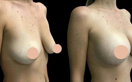 The Recovery Process After Breast Augmentation Trusted Tips from the Best Doctors in Dubai