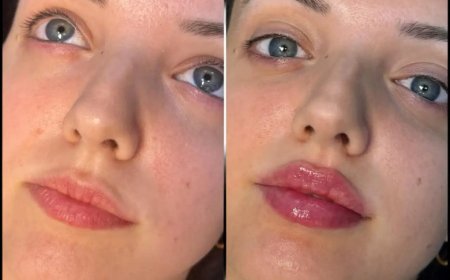 Choosing the Right Clinic: Best Aesthetic Clinics in Dubai for Fillers