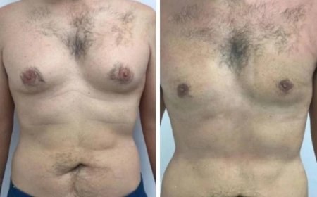 Understanding the Difference Between Fat and Glandular Tissue in Gynecomastia in Dubai