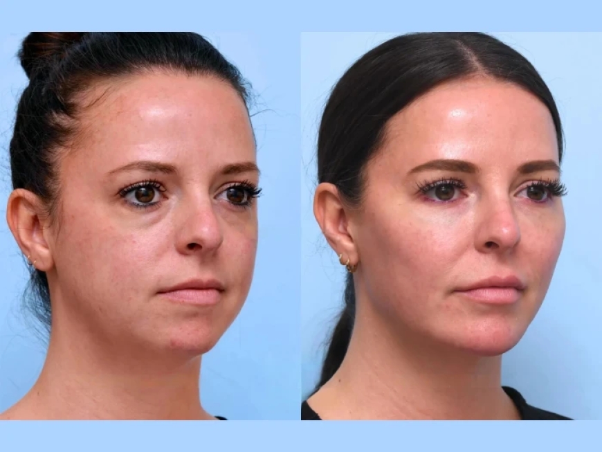 Is Thread Lift Treatment in Dubai the Best Solution for Wrinkles and Sagging Skin?
