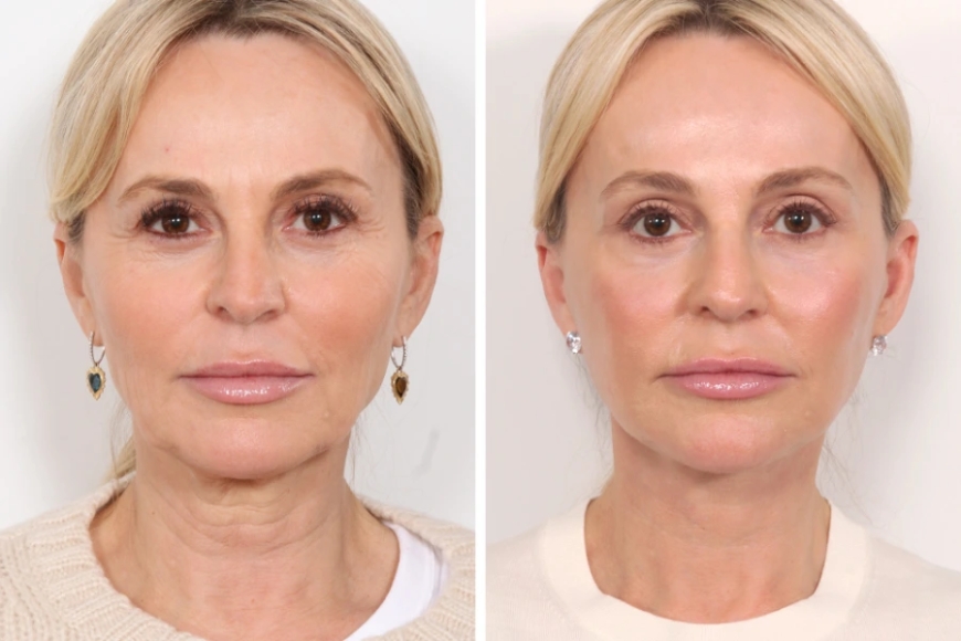 How Thread Lift Enhances Your Look According to the Best Aesthetic Clinic in Dubai